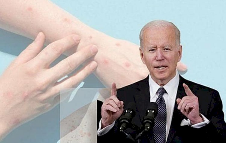 ಹೆಚ್ಚಿದ ಮಂಕಿಪಾಕ್ಸ್‌ ಆತಂಕ; ಆರೋಗ್ಯ ತುರ್ತು ಪರಿಸ್ಥಿತಿ ಘೋಷಿಸಿದ ಅಮೆರಿಕ