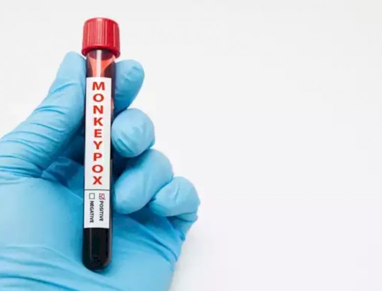 ದಿಲ್ಲಿಯಲ್ಲಿ 5ನೇ ಮಂಕಿಪಾಕ್ಸ್ ಪ್ರಕರಣ: ನೈಜೀರಿಯಾದಿಂದ ಬಂದ ಮಹಿಳೆಗೆ ಸೋಂಕು