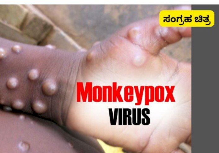 ಮಂಗಳೂರು: ಉಡುಪಿ ಮೂಲದ ವ್ಯಕ್ತಿಗೆ ಮಂಕಿಫಾಕ್ಸ್ ದೃಢ- ಮಂಗಳೂರಿನಲ್ಲಿ ಚಿಕಿತ್ಸೆ